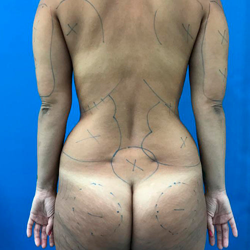 Abdominoplastía