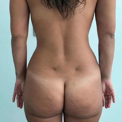 Abdominoplastía