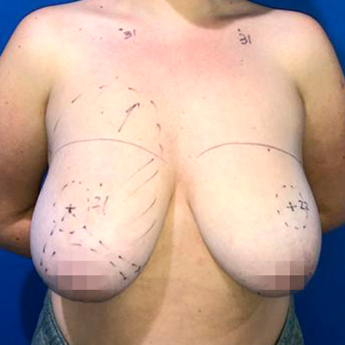 Reducción mamaria