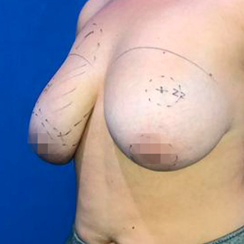Reducción mamaria