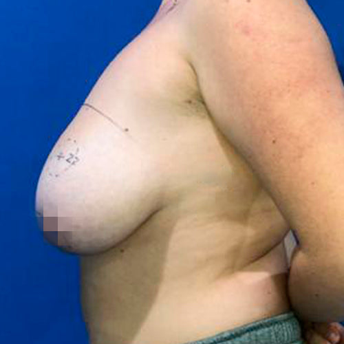 Reducción mamaria