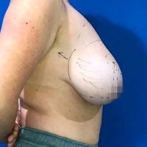 Reducción mamaria