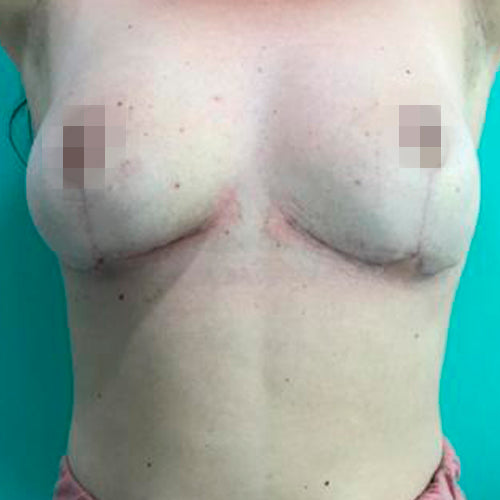 Reducción mamaria