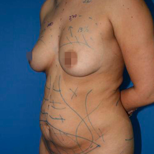 Abdominoplastía