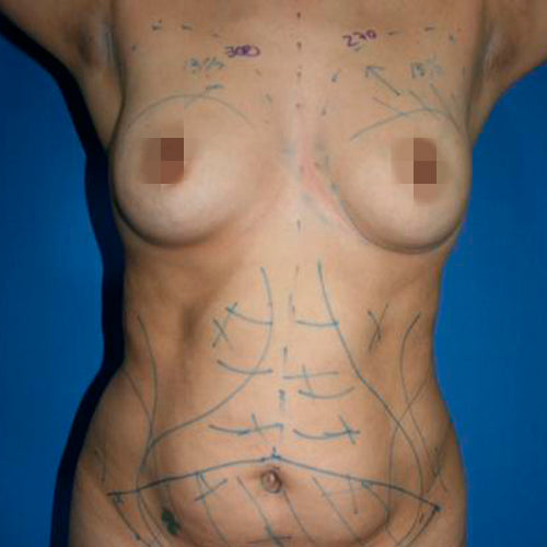 Abdominoplastía