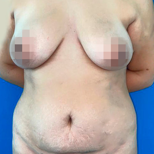 Abdominoplastía