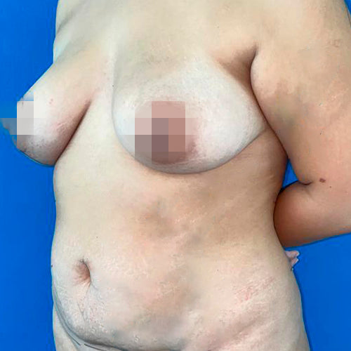 Abdominoplastía