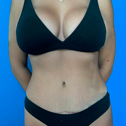 Abdominoplastía