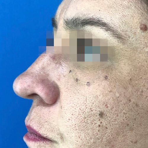 Blefaroplastía (cirugía en los párpados)