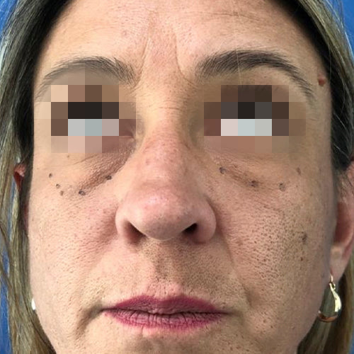 Blefaroplastía (cirugía en los párpados)