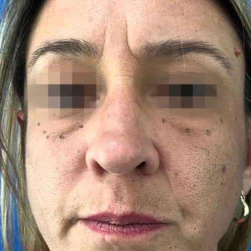 Blefaroplastía (cirugía en los párpados)