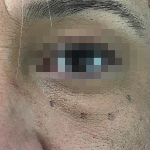 Blefaroplastía (cirugía en los párpados)