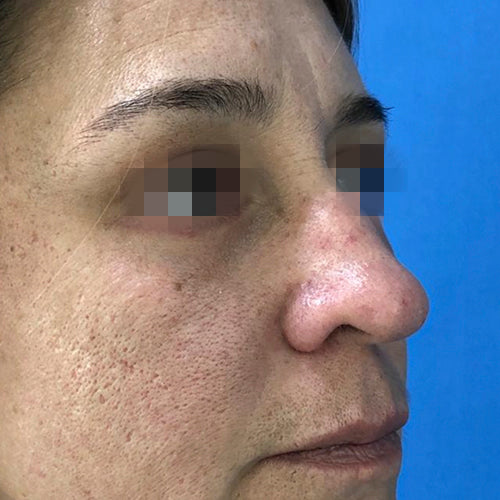 Blefaroplastía (cirugía en los párpados)