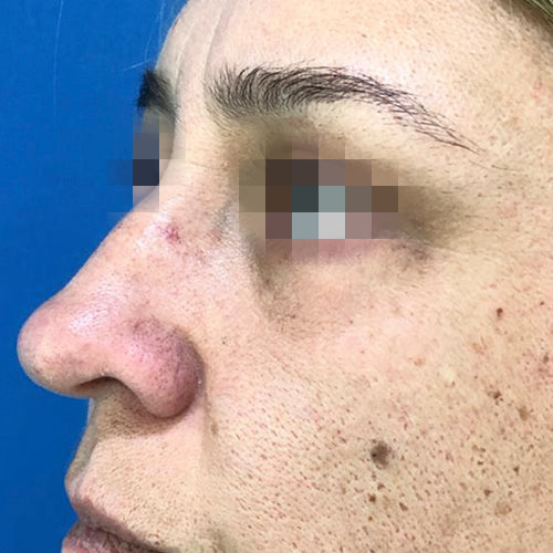 Blefaroplastía (cirugía en los párpados)