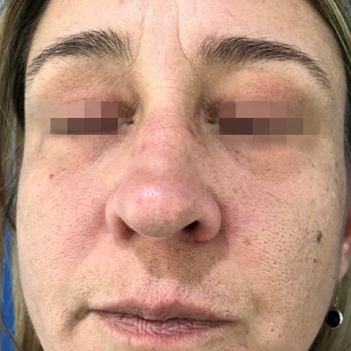 Blefaroplastía (cirugía en los párpados)