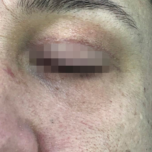 Blefaroplastía (cirugía en los párpados)