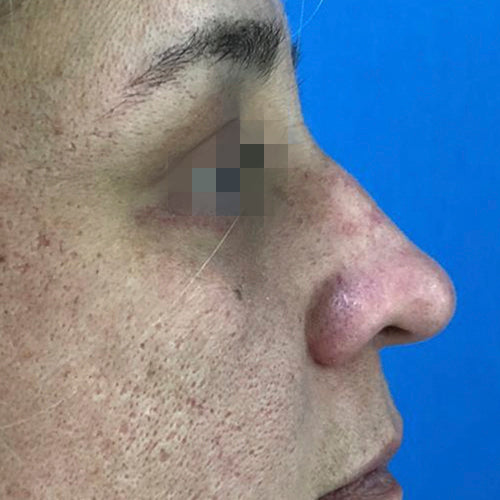 Blefaroplastía (cirugía en los párpados)