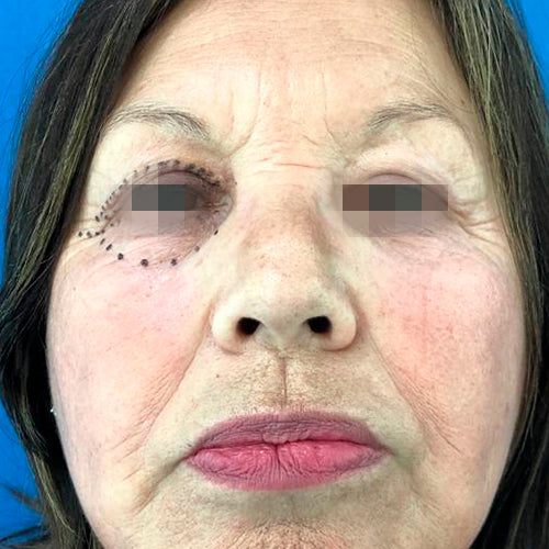 Blefaroplastía (cirugía en los párpados)