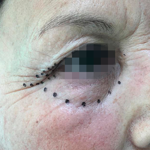 Blefaroplastía (cirugía en los párpados)