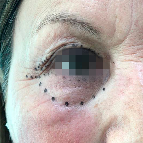 Blefaroplastía (cirugía en los párpados)