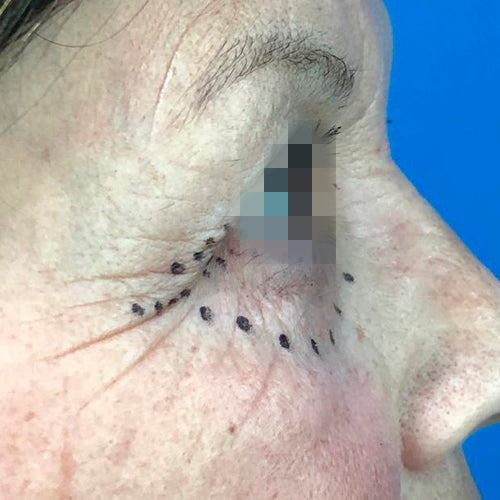 Blefaroplastía (cirugía en los párpados)