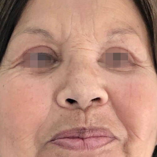 Blefaroplastía (cirugía en los párpados)