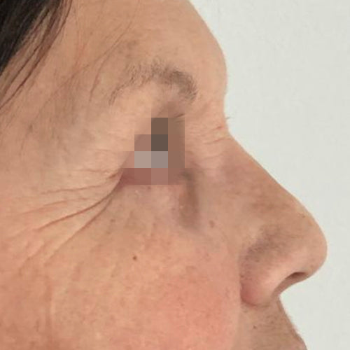 Blefaroplastía (cirugía en los párpados)