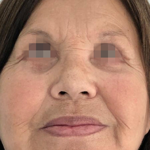 Blefaroplastía (cirugía en los párpados)