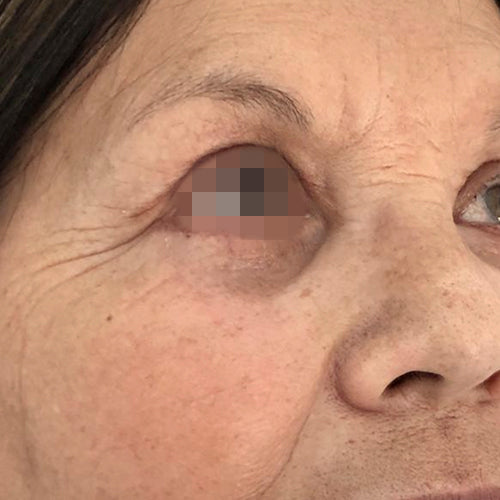 Blefaroplastía (cirugía en los párpados)