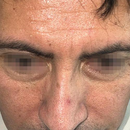 Blefaroplastía (cirugía en los párpados)