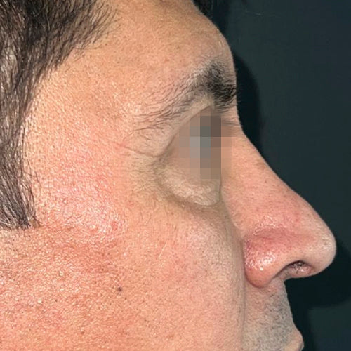 Blefaroplastía (cirugía en los párpados)