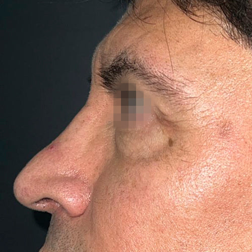 Blefaroplastía (cirugía en los párpados)