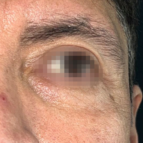 Blefaroplastía (cirugía en los párpados)