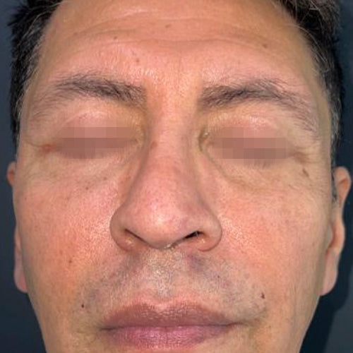 Blefaroplastía (cirugía en los párpados)