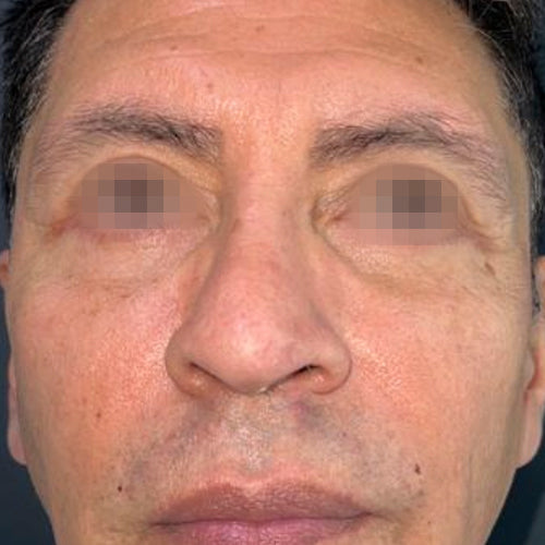 Blefaroplastía (cirugía en los párpados)