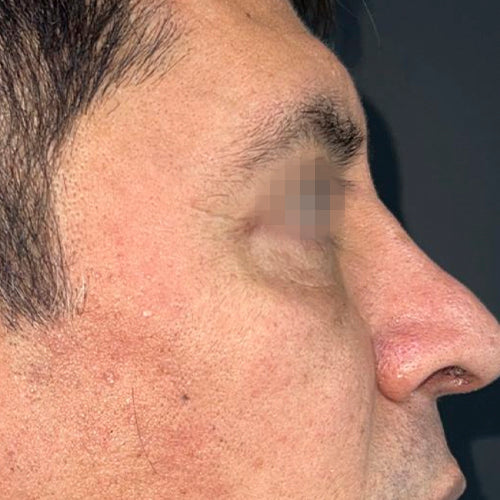 Blefaroplastía (cirugía en los párpados)