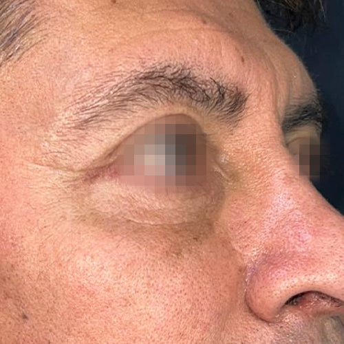 Blefaroplastía (cirugía en los párpados)