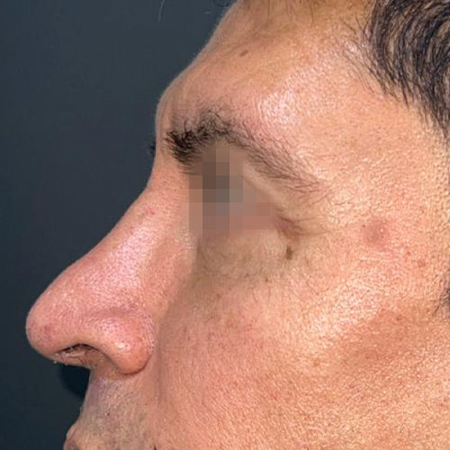 Blefaroplastía (cirugía en los párpados)