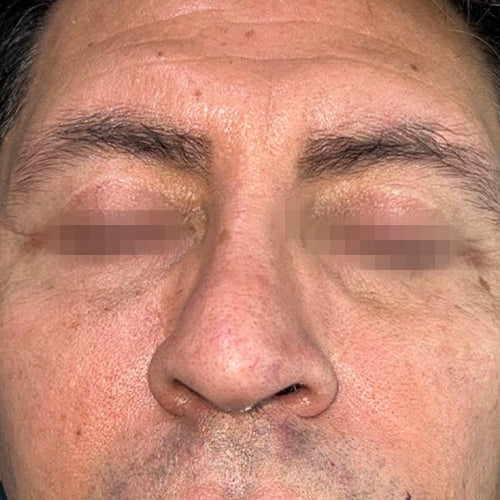 Blefaroplastía (cirugía en los párpados)