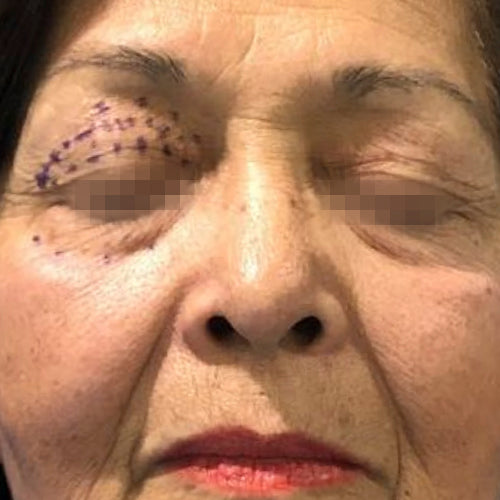 Blefaroplastía (cirugía en los párpados)