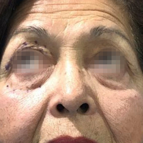 Blefaroplastía (cirugía en los párpados)