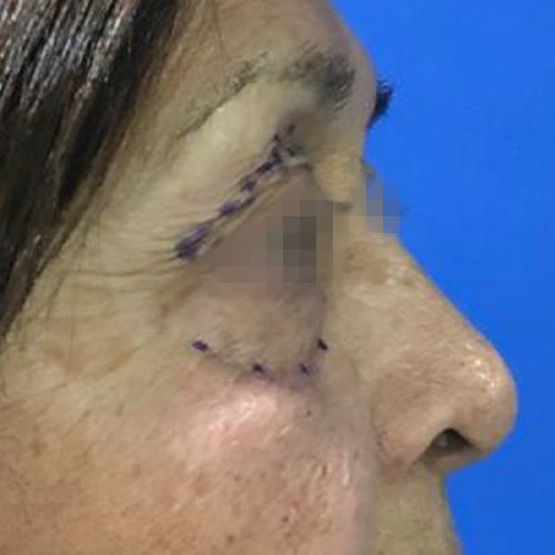 Blefaroplastía (cirugía en los párpados)