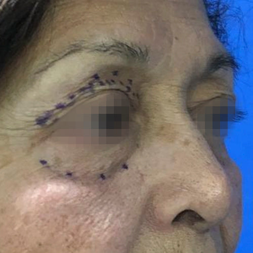 Blefaroplastía (cirugía en los párpados)