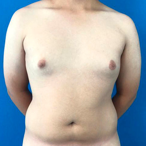 Ginecomastia (Hombre)