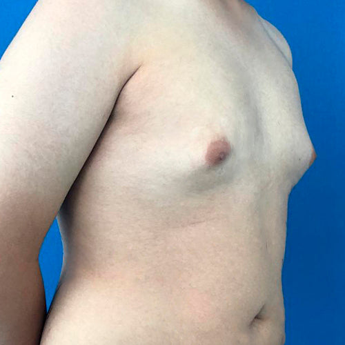 Ginecomastia (Hombre)