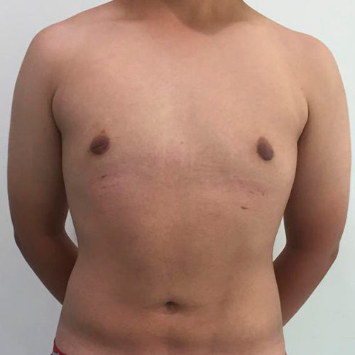 Ginecomastia (Hombre)