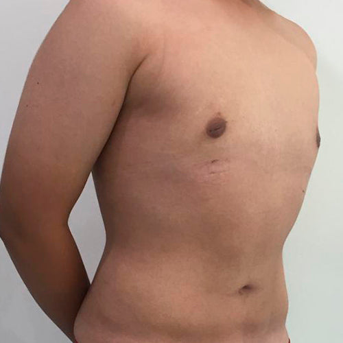 Ginecomastia (Hombre)