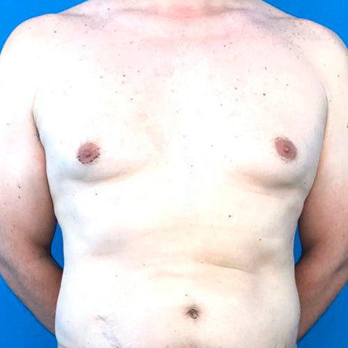Ginecomastia (Hombre)