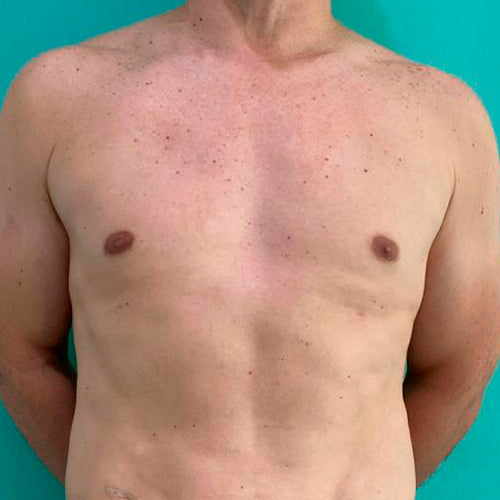 Ginecomastia (Hombre)