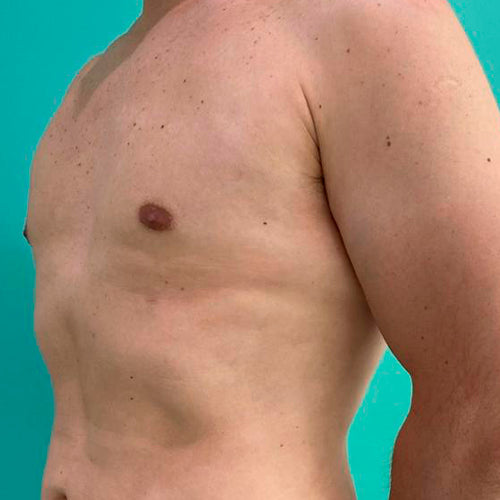 Ginecomastia (Hombre)